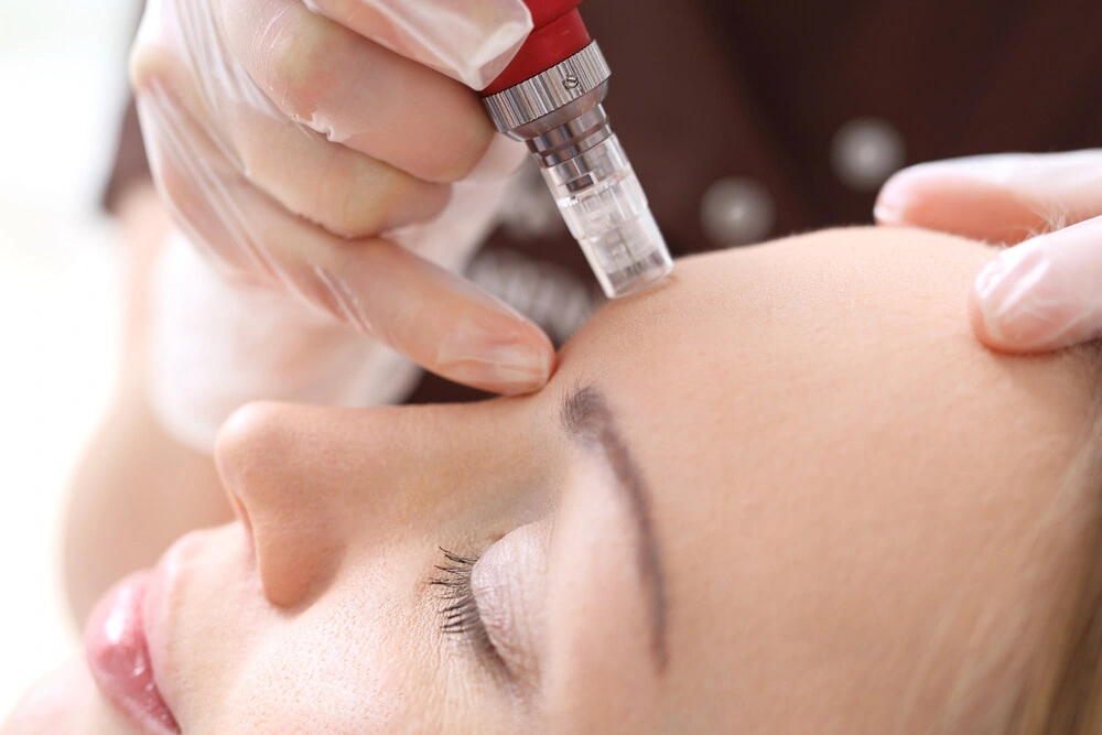 Needle mesotherapy, Microneedle mesotherapy, treatment woman at the beautician